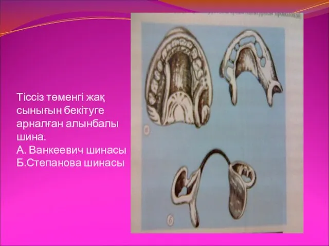 Тіссіз төменгі жақ сынығын бекітуге арналған алынбалы шина. А. Ванкеевич шинасы Б.Степанова шинасы