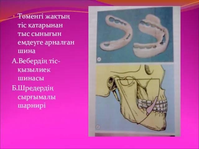 Төменгі жақтың тіс қатарынан тыс сынығын емдеуге арналған шина А.Вебердің тіс- қызылиек шинасы Б.Шредердің сырғымалы шарнирі