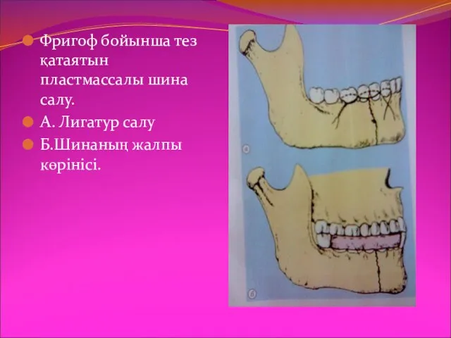 Фригоф бойынша тез қатаятын пластмассалы шина салу. А. Лигатур салу Б.Шинаның жалпы көрінісі.