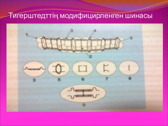 Тигерштедттің модифицирленген шинасы