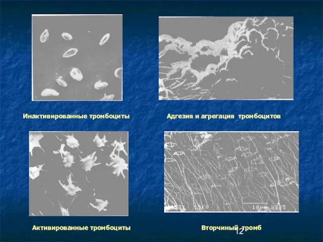 Инактивированные тромбоциты Активированные тромбоциты Адгезия и агрегация тромбоцитов Вторчиный тромб