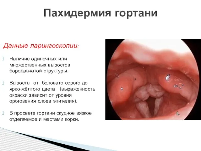 Пахидермия гортани Данные ларингоскопии: Наличие одиночных или множественных выростов бородавчатой структуры.