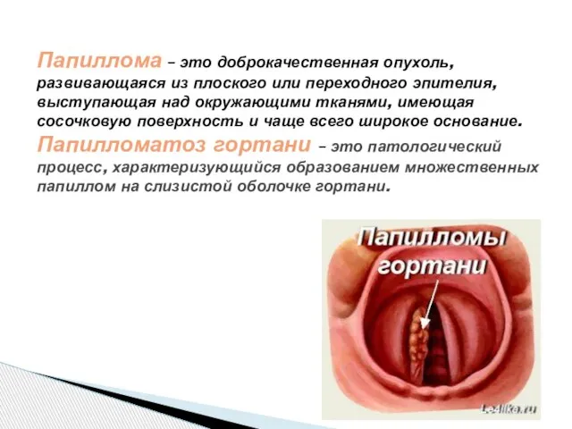 Папиллома – это доброкачественная опухоль, развивающаяся из плоского или переходного эпителия,