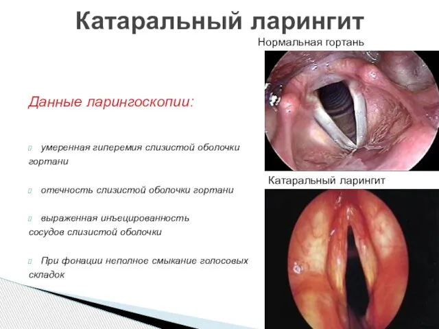 Данные ларингоскопии: умеренная гиперемия слизистой оболочки гортани отечность слизистой оболочки гортани