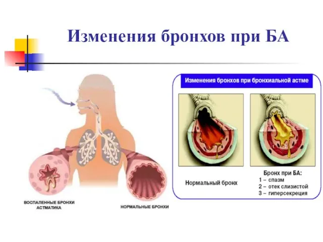 Изменения бронхов при БА