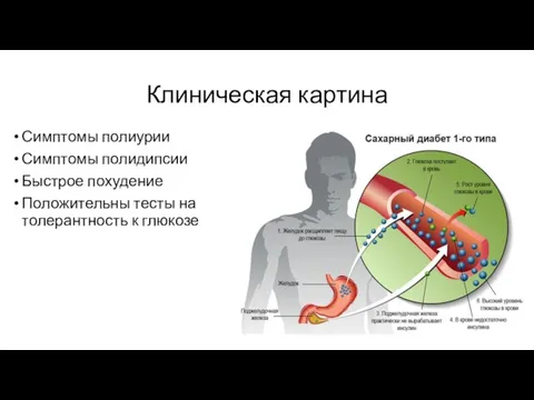 Клиническая картина Симптомы полиурии Симптомы полидипсии Быстрое похудение Положительны тесты на толерантность к глюкозе