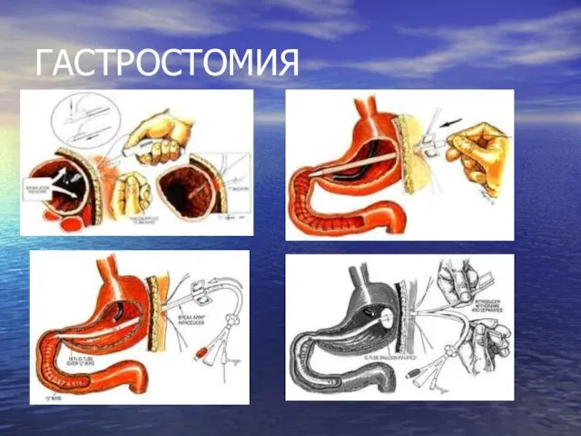 ГАСТРОСТОМИЯ