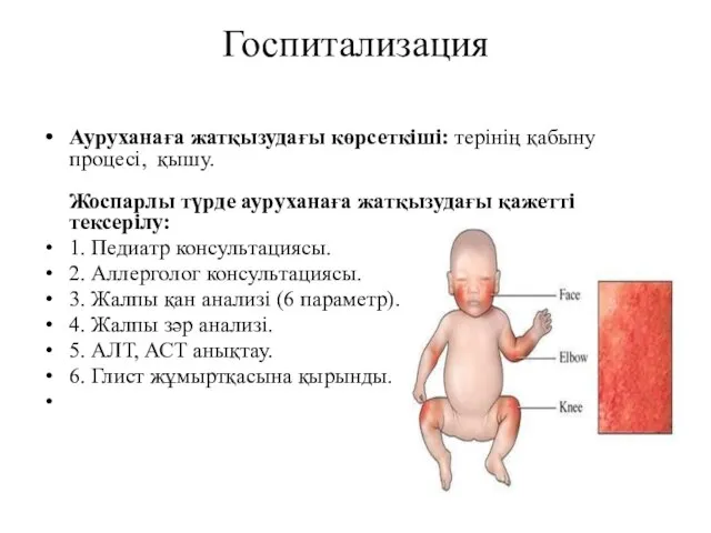 Госпитализация Ауруханаға жатқызудағы көрсеткіші: терінің қабыну процесі, қышу. Жоспарлы түрде ауруханаға