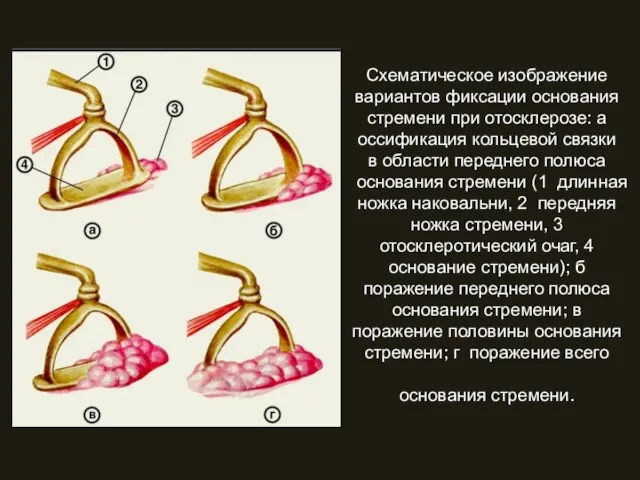 Схематическое изображение вариантов фиксации основания стремени при отосклерозе: а оссификация кольцевой