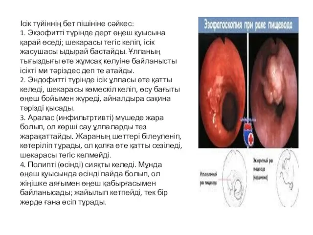 Ісік түйіннің бет пішініне сәйкес: 1. Экзофитті түрінде дерт өңеш қуысына