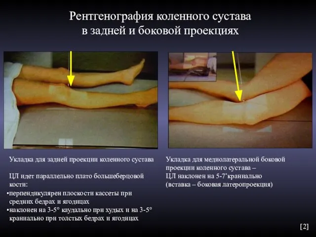 Рентгенография коленного сустава в задней и боковой проекциях Укладка для медиолатеральной