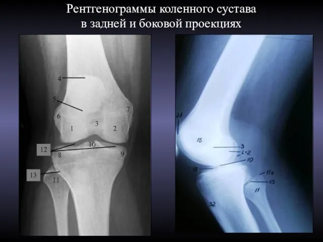 Рентгенограммы коленного сустава в задней и боковой проекциях 4 5 1