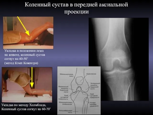 Коленный сустав в передней аксиальной проекции Укладка в положении лежа на