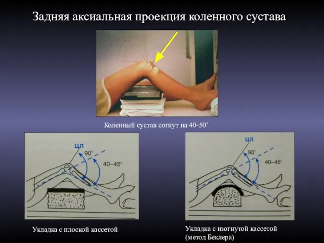 Задняя аксиальная проекция коленного сустава Коленный сустав согнут на 40-50˚ Укладка