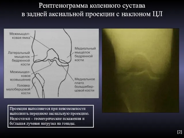 Рентгенограмма коленного сустава в задней аксиальной проекции с наклоном ЦЛ Проекция