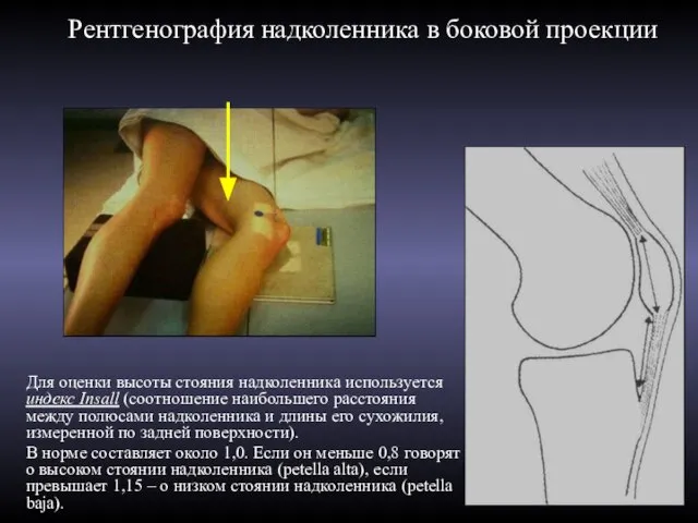 Рентгенография надколенника в боковой проекции Для оценки высоты стояния надколенника используется