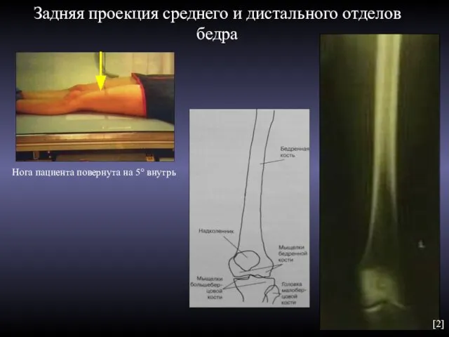 Задняя проекция среднего и дистального отделов бедра Нога пациента повернута на 5° внутрь [2]