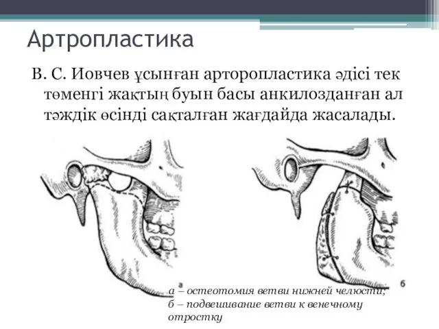 Артропластика В. С. Иовчев ұсынған арторопластика әдісі тек төменгі жақтың буын