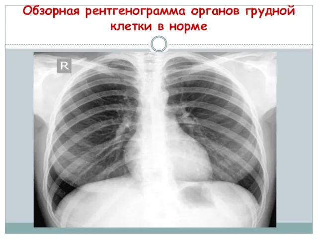 Обзорная рентгенограмма органов грудной клетки в норме
