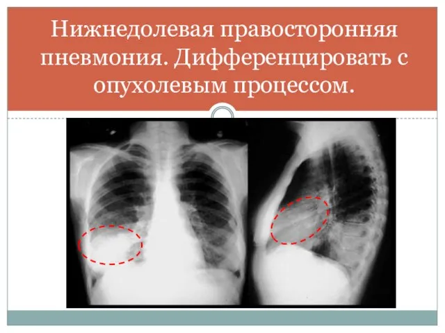 Нижнедолевая правосторонняя пневмония. Дифференцировать с опухолевым процессом.