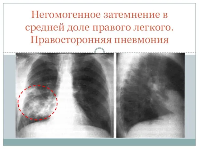 Негомогенное затемнение в средней доле правого легкого. Правосторонняя пневмония