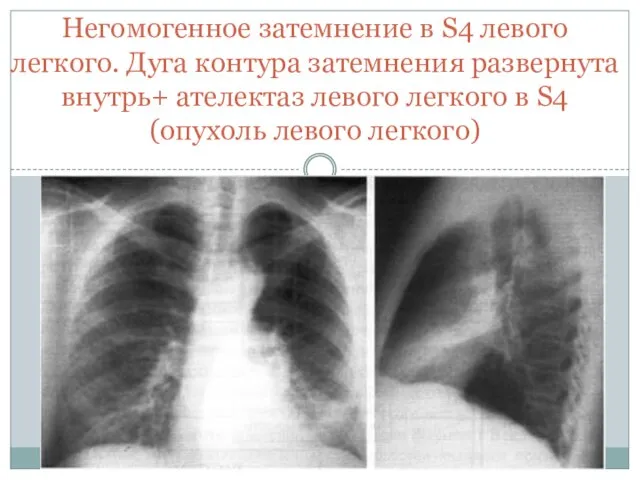 Негомогенное затемнение в S4 левого легкого. Дуга контура затемнения развернута внутрь+