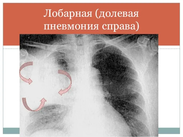 Лобарная (долевая пневмония справа)