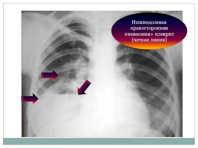 Нижнедолевая правосторонняя пневмония+ плеврит (четкая линия)
