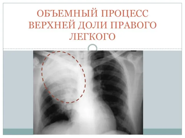 ОБЪЕМНЫЙ ПРОЦЕСС ВЕРХНЕЙ ДОЛИ ПРАВОГО ЛЕГКОГО