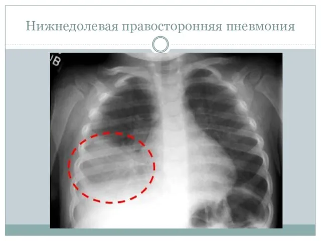 Нижнедолевая правосторонняя пневмония