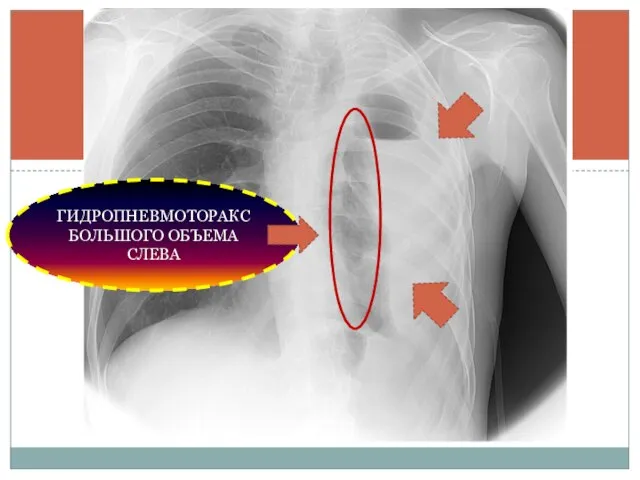 ГИДРОПНЕВМОТОРАКС БОЛЬШОГО ОБЪЕМА СЛЕВА