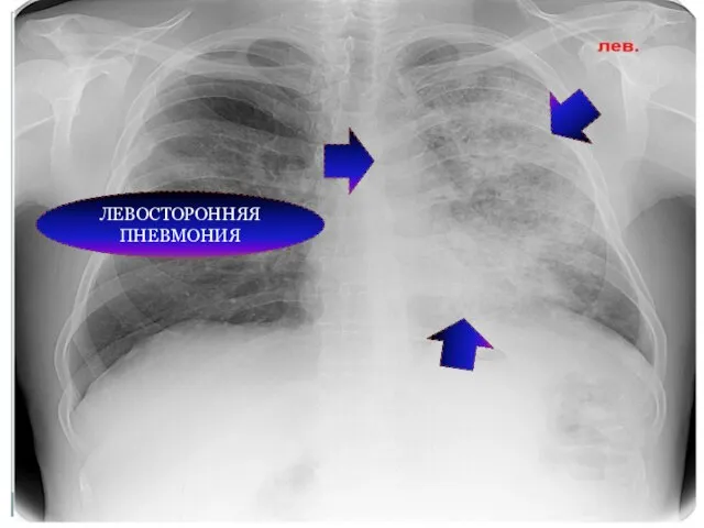 ЛЕВОСТОРОННЯЯ ПНЕВМОНИЯ