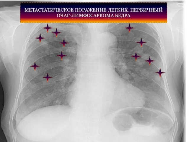 МЕТАСТАТИЧЕСКОЕ ПОРАЖЕНИЕ ЛЕГКИХ. ПЕРВИЧНЫЙ ОЧАГ-ЛИМФОСАРКОМА БЕДРА