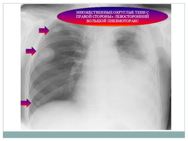 МНОЖЕСТВЕННЫЕ ОКРУГЛЫЕ ТЕНИ С ПРАВОЙ СТОРОНЫ+ ЛЕВОСТОРОННИЙ БОЛЬШОЙ ПНЕВМОТОРАКС