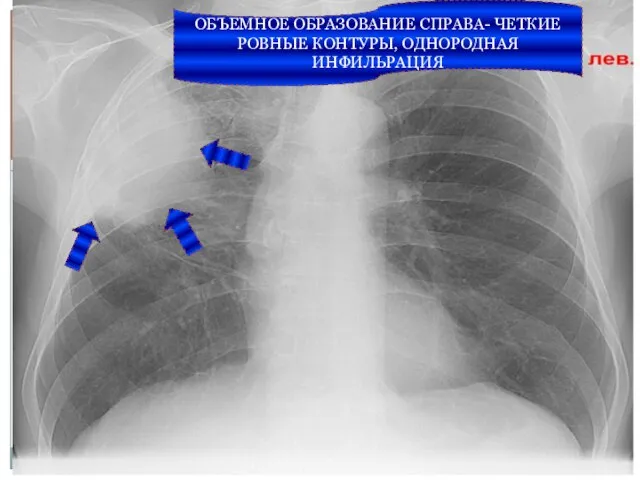 ОБЪЕМНОЕ ОБРАЗОВАНИЕ СПРАВА- ЧЕТКИЕ РОВНЫЕ КОНТУРЫ, ОДНОРОДНАЯ ИНФИЛЬРАЦИЯ