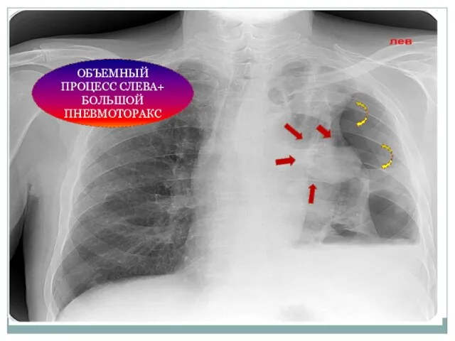 ОБЪЕМНЫЙ ПРОЦЕСС СЛЕВА+ БОЛЬШОЙ ПНЕВМОТОРАКС
