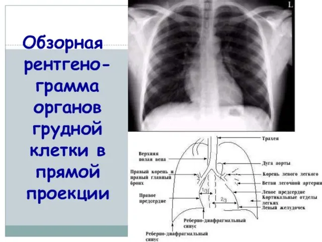 Обзорная рентгено-грамма органов грудной клетки в прямой проекции