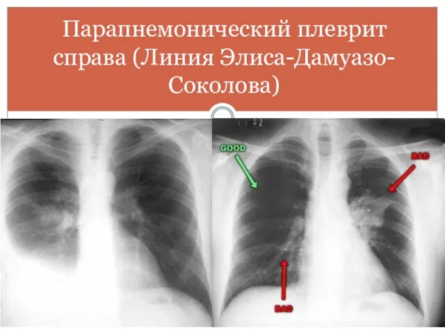 Парапнемонический плеврит справа (Линия Элиса-Дамуазо-Соколова)