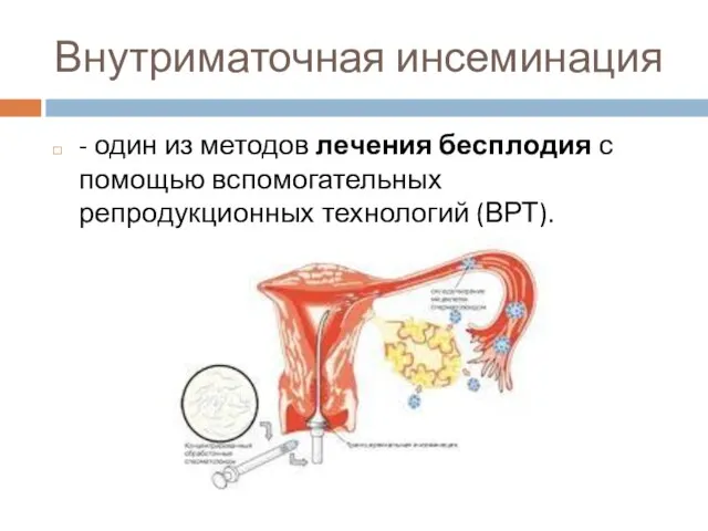 Внутриматочная инсеминация - один из методов лечения бесплодия с помощью вспомогательных репродукционных технологий (ВРТ).