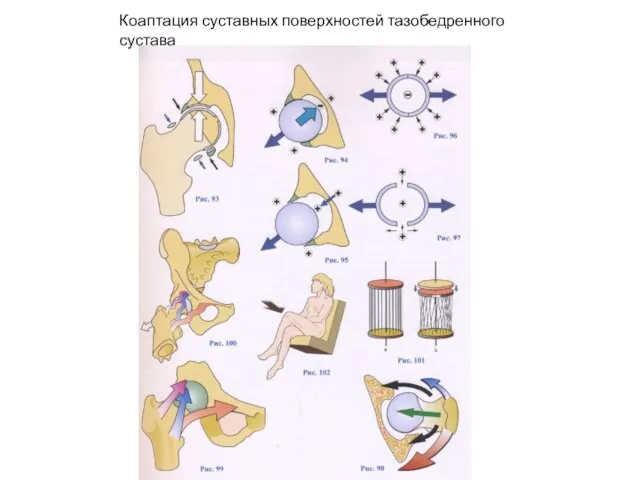 Коаптация суставных поверхностей тазобедренного сустава