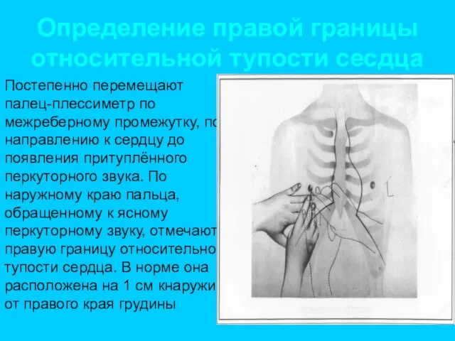 Определение правой границы относительной тупости сесдца Постепенно перемещают палец-плессиметр по межреберному