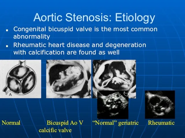 Aortic Stenosis: Etiology Congenital bicuspid valve is the most common abnormality