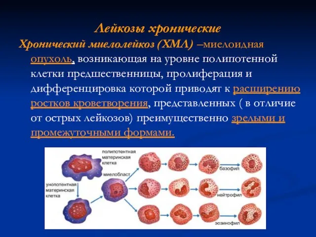 Лейкозы хронические Хронический миелолейкоз (ХМЛ) –миелоидная опухоль, возникающая на уровне полипотенной