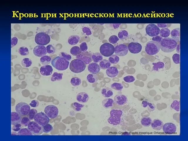 Кровь при хроническом миелолейкозе