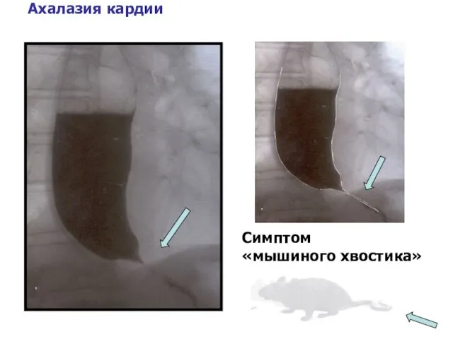 Ахалазия кардии Симптом «мышиного хвостика»