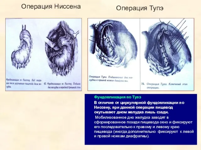 Операция Ниссена Операция Тупэ Фундопликация по Тупэ В отличие от циркулярной