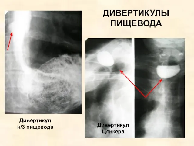 ДИВЕРТИКУЛЫ ПИЩЕВОДА Дивертикул Ценкера Дивертикул н/3 пищевода