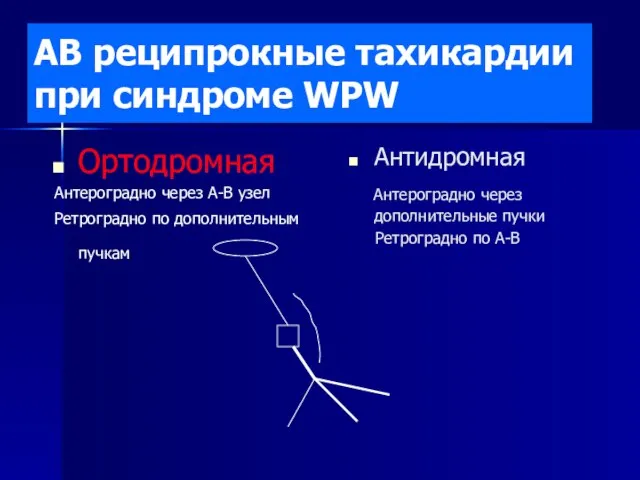 АВ реципрокные тахикардии при синдроме WPW Ортодромная Антероградно через А-В узел