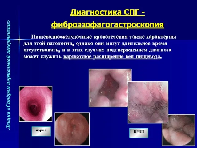 Пищеводно-желудочные кровотечения также характерны для этой патологии, однако они могут длительное