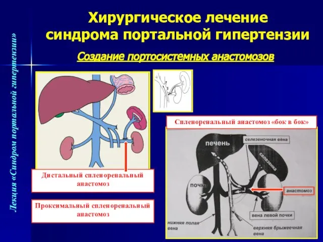 Хирургическое лечение синдрома портальной гипертензии Создание портосистемных анастомозов Спленоренальный анастомоз «бок